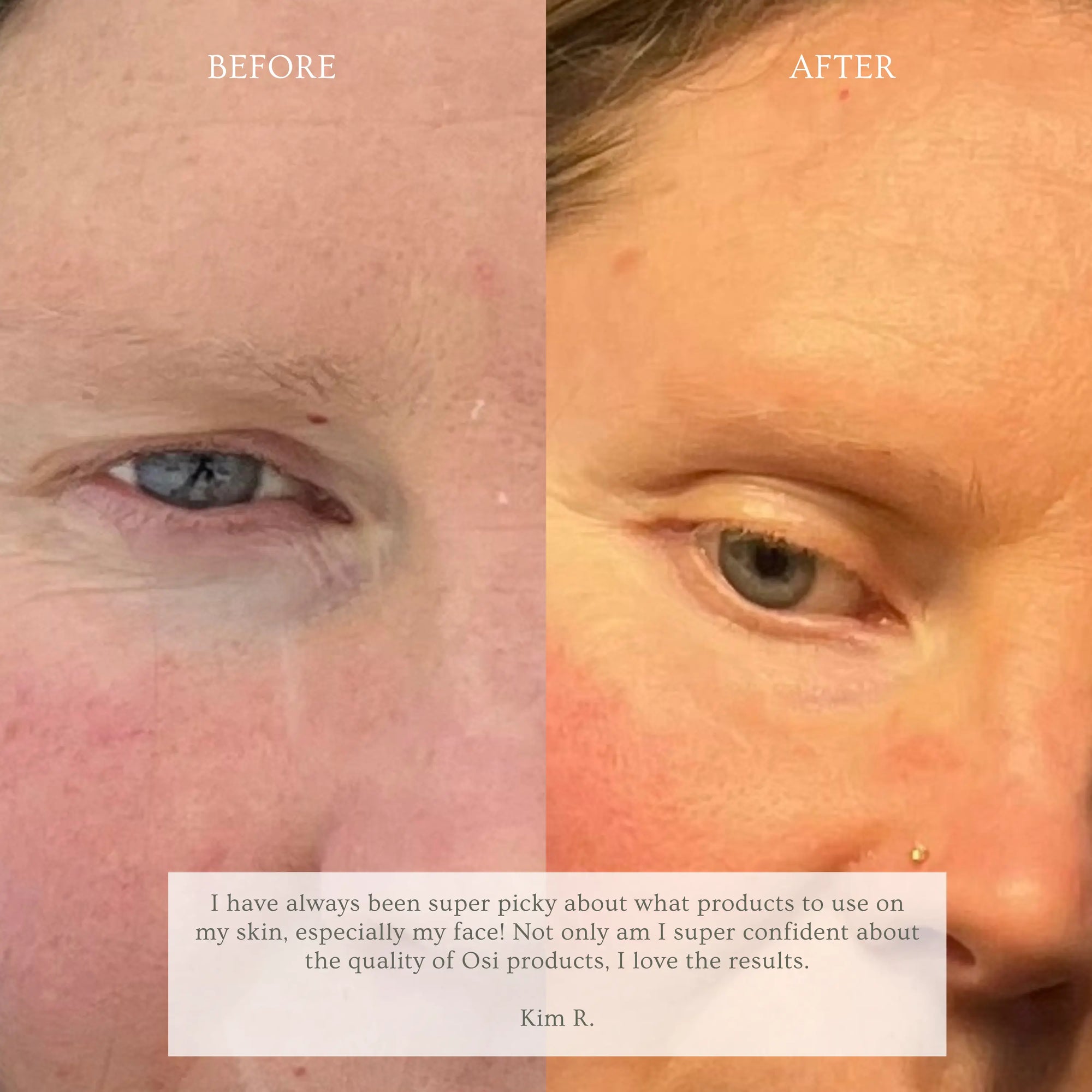 Before and after facial skin comparison on a woman's face, showing improvement around the eye area. The left side is labeled BEFORE and shows puffiness/swelling under the eye; the right side is labeled AFTER and shows a flatter, less swollen appearance.