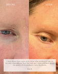 Before and after facial skin comparison on a woman's face, showing improvement around the eye area. The left side is labeled BEFORE and shows puffiness/swelling under the eye; the right side is labeled AFTER and shows a flatter, less swollen appearance.